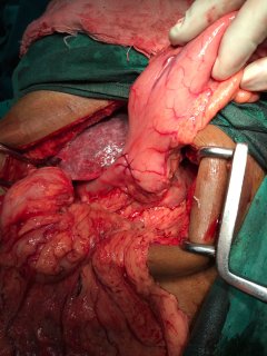 Esophagectomy1