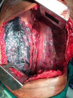 Esophagectomy3