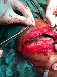 Esophagectomy4