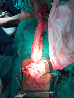 Esophagectomy5