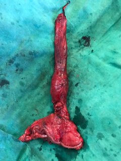 Esophagectomy6